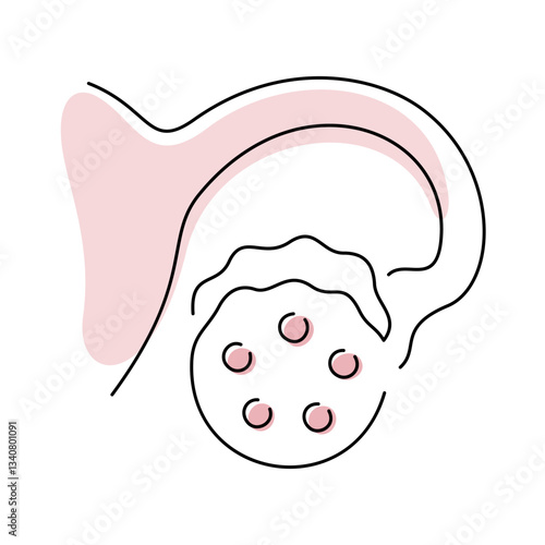 PCOS, Polycystic Ovary Syndrome medical illustration