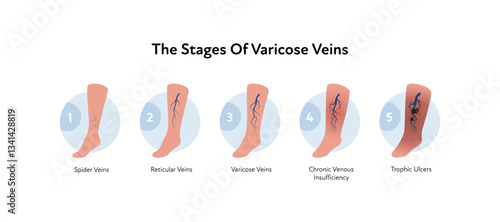 Varicose disease for healthcare infographic. Vector flat chart illustration. Vascular disease diagnostic and treatment. Stages of varicose disease and vein changing. Design for education