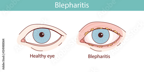 Blepharitis of the eye vector anatomical illustration
