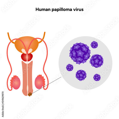 Human papilloma virus in zoom view in human reproductive system. Hpv in human