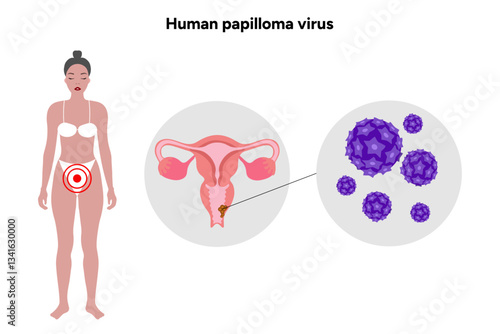 Human papilloma virus in zoom view in human reproductive system. Hpv in human