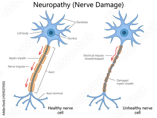 healthy and damaged nerve cells, showing myelin sheath deterioration, slowed nerve impulses, and effects of neuropathy on neural communication diagram hand drawn vector illustration. Medical science