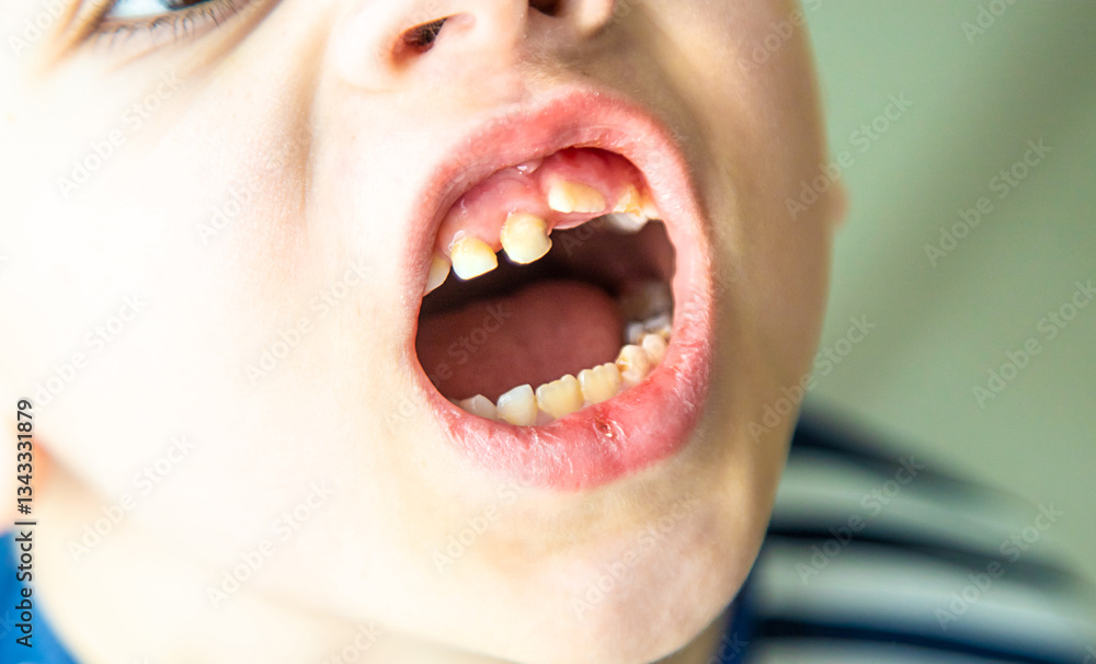 The child has bad teeth. Selective focus. The child has bad teeth. Selective focus.