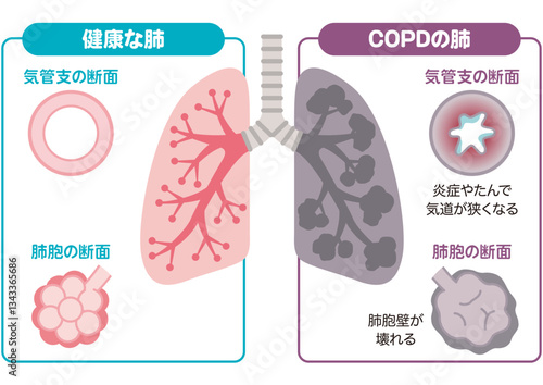 健康な肺とCOPDの肺
