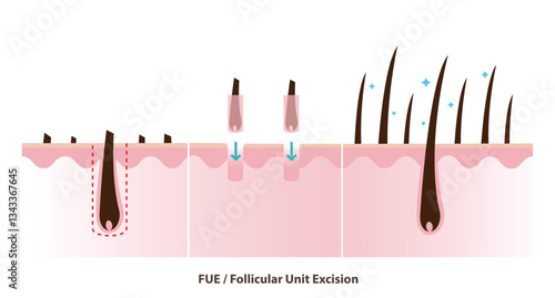 FUE hair transplant illustration. Follicular unit excision, technique that uses a device to extract hair grafts one by one from the donor area, transplanted into the target area. Hair care concept.