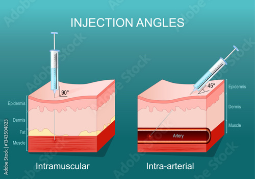 Intra-arterial and Intramuscular injections
