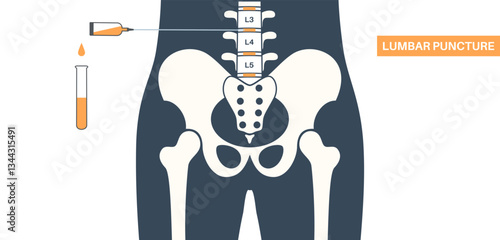 Lumbar puncture spinal tap