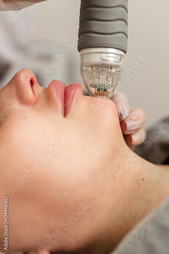 Attractive young woman undergoing a cosmetic procedure in a beauty salon. A woman undergoes fractional RF lifting against a light background