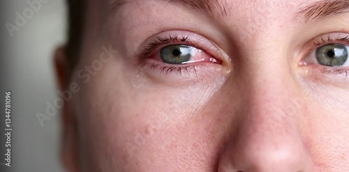 Close up of a woman applying eyedrops on red infected eye with conjunctivitis at home