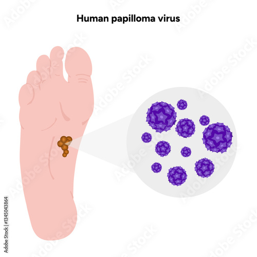 Human papilloma virus in zoom view on human feet. Hpv in human