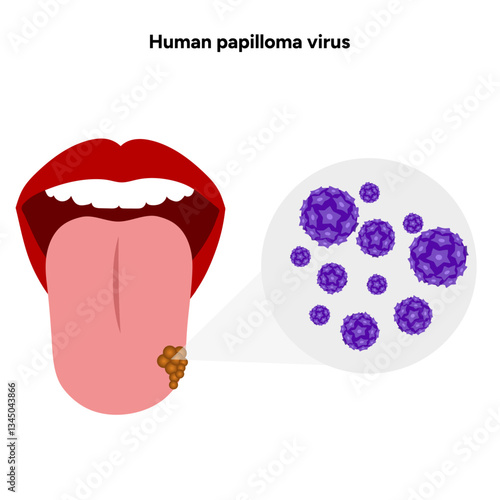 Human papilloma virus in zoom view on human tongue. Hpv in human
