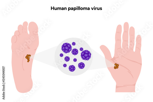 Human papilloma virus in zoom view on human feet and hand. Hpv in human