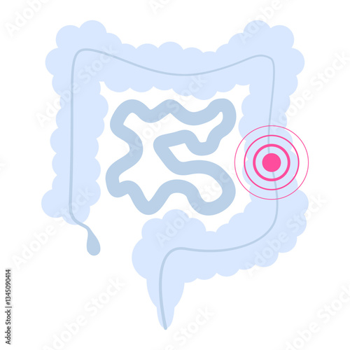 IBS (irritable bowel syndrome), Colorectal Cancer, Bowel, Crohn’s and Colitis Cancer Awareness. Treatment and prevention. Digestive system. Medicine and health