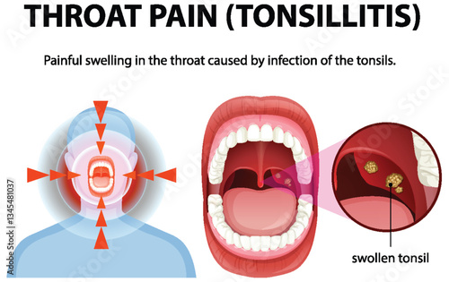 Understanding Throat Pain and Tonsillitis