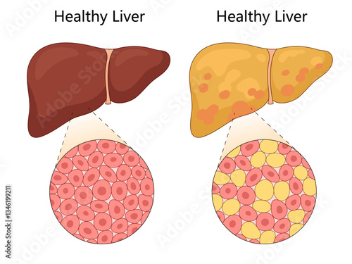 healthy liver with a fatty liver, showing normal liver cells versus fat accumulation due to hepatic steatosis diagram hand drawn schematic vector illustration. Medical science educational illustration