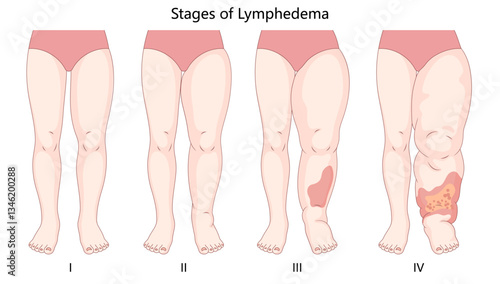 four stages of lymphedema, depicting progressive leg swelling, skin changes, and fluid retention due to lymphatic dysfunction diagram hand drawn vector illustration. Medical science educational