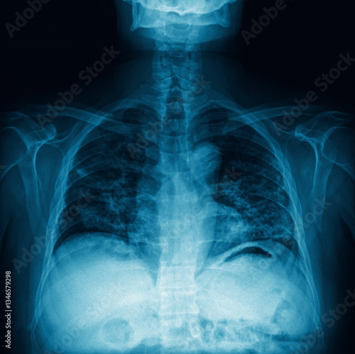 Chest X-ray showing lungs, spine, and ribs with medical imaging detail. Close-up of shoulder joint, injuries of tendons and bones. Medical diagnostics, internal anatomy and health film concept