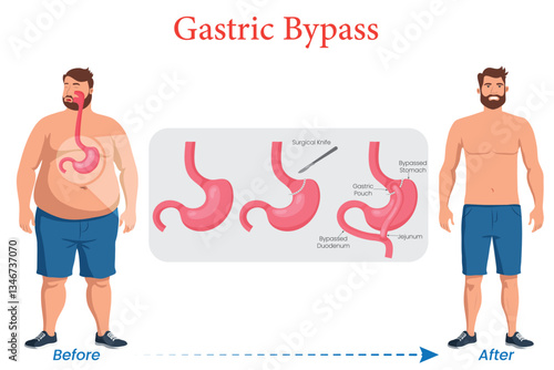 Gastric Bypass A Life Changing Weight Loss Surgery