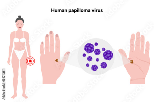 Human papilloma virus on hands. Medical screening illustration in zoom