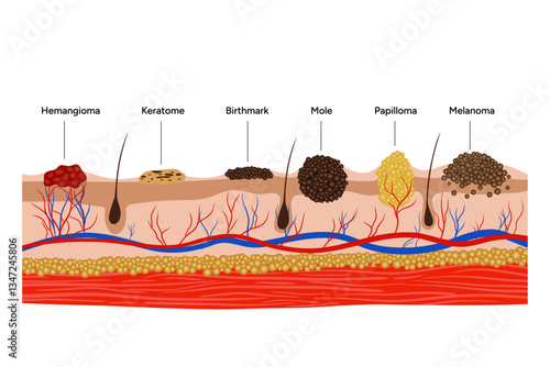 Human papilloma virus, hemangioma, keratome, birthmark, mole, melanoma. Medical screening illustration in zoom