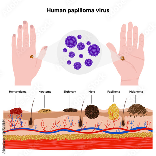 Human papilloma virus on hands. Medical screening illustration in zoom. Hemangioma, keratome, birthmark, mole, melanoma