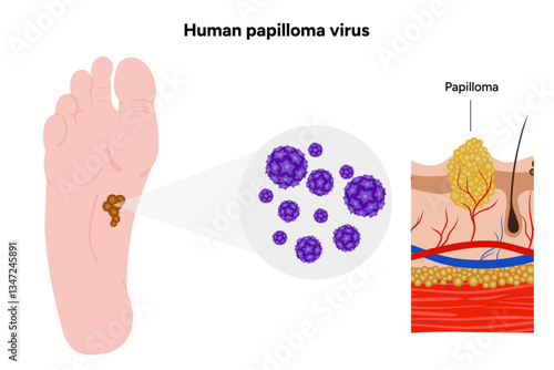 Human papillomavirus on feet. Medical screening illustration in zoom