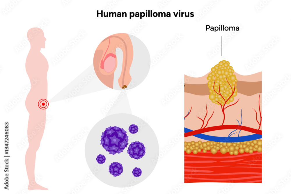 Obraz premium Human papilloma virus on reproductive system. Medical screening illustration in zoom