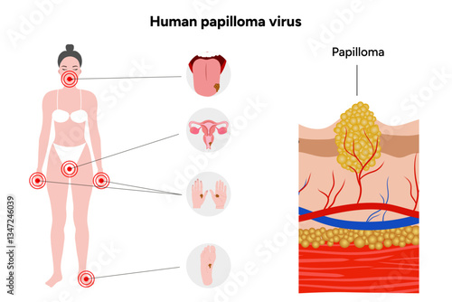 Human papillomavirus on tongue, reproductive system, hands, and feet. Medical screening illustration