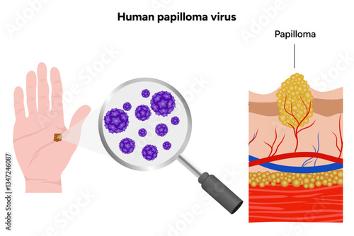 Human papilloma virus on hands. Medical screening illustration in zoom