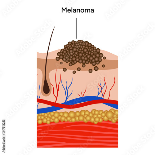 Human melanoma skin disease microbiology. Medical screening illustration in zoom
