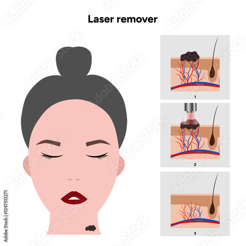 Laser remover of different types of skin lesions papillon, birthmark, mole, melanoma, keratome, hemangioma