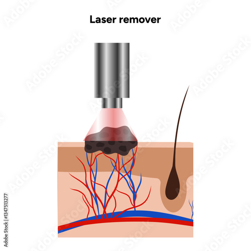 Laser remover of different types of skin lesions papillon, birthmark, mole, melanoma, keratome, hemangioma
