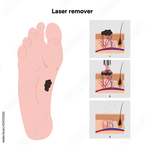Laser remover of different types of skin lesions papillon, birthmark, mole, melanoma, keratome, hemangioma