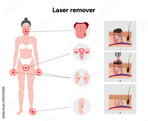 Laser remover of different types of skin lesions papillon, birthmark, mole, melanoma, keratome, hemangioma
