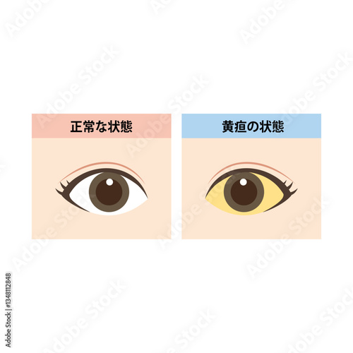 正常な目と白目に黄疸が出ている目の比較イラスト