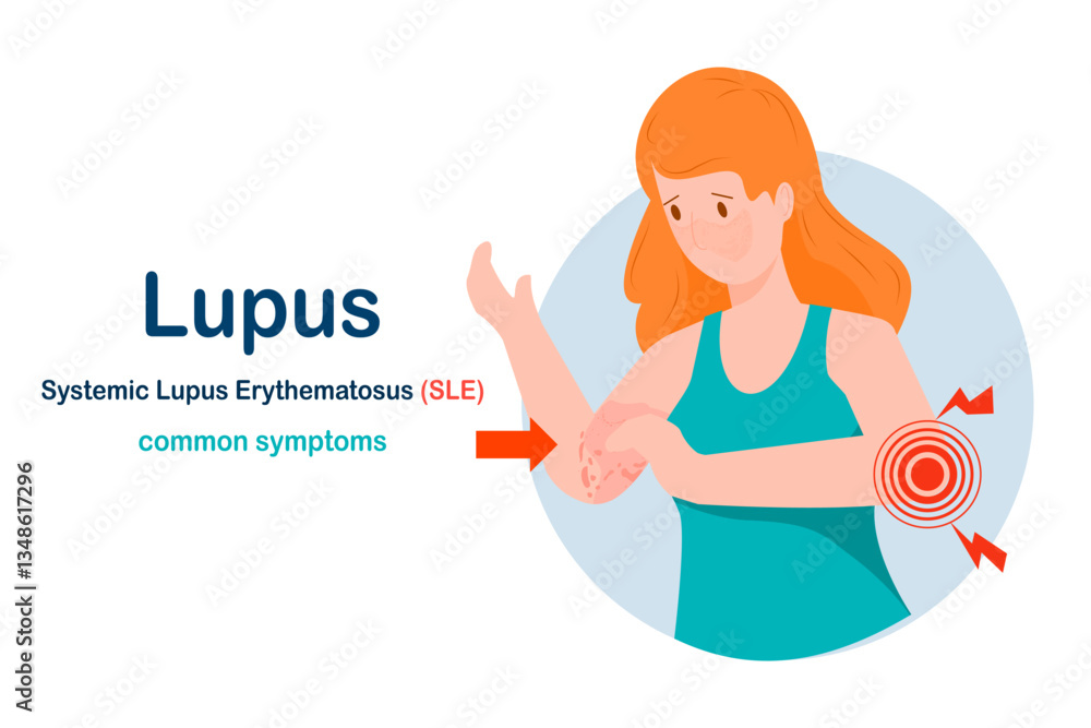 Vector illustration in flat style.common symptoms of Lupus,concept of health care and medical. Vector illustration in flat style.common symptoms of Lupus,concept of health care and medical.