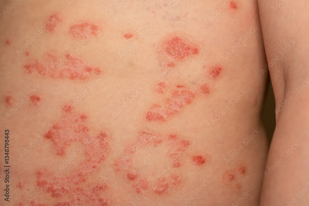 Fototapeta premium Psoriasis skin condition displaying red and scaly patches on the back of an individual