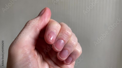 Woman show fingers with nail fungus close up