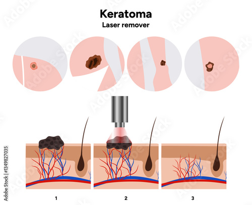 Human keratome skin disease microbiology. Medical screening illustration in zoom. Laser remover