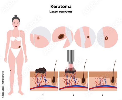 Human keratome skin disease microbiology. Medical screening illustration in zoom. Laser remover