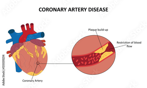 Coronary Artery Disease vector illustration