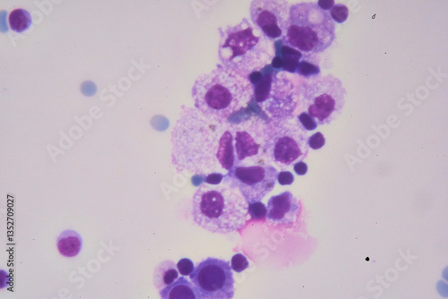 Obraz na płótnie Medical themes: Pleural effusion showing chylothorax caused by B-cell lymphoma w salonie