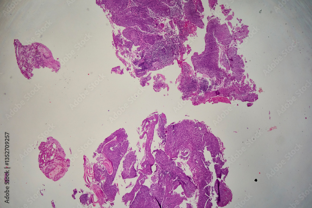Medical themes: Bronchial biopsy showing squamous cell carcinoma