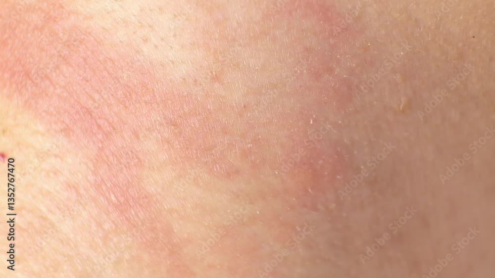 Detailed view of irritated skin with redness and inflammation. Emphasizes the importance of dermatology and proper skincare. Detailed view of irritated skin with redness and inflammation. Emphasizes the importance of dermatology and proper skincare.