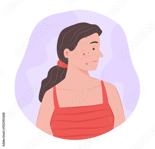 Woman with Acne and Scar on Face for Dermatological Symptom Concept Illustration Clip Art