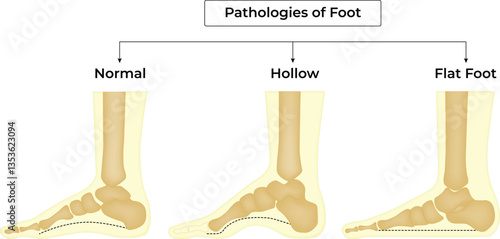 Foot pathologies normal hollow and flat foot anatomy comparison