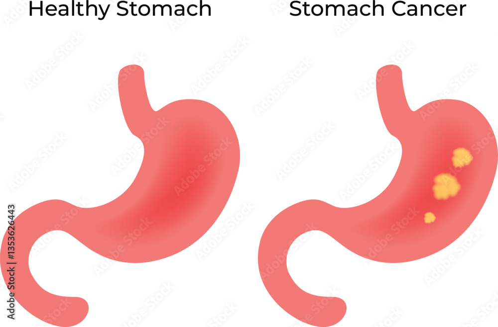 Healthy vs Cancerous Stomach Vector Illustration Healthy vs Cancerous Stomach Vector Illustration