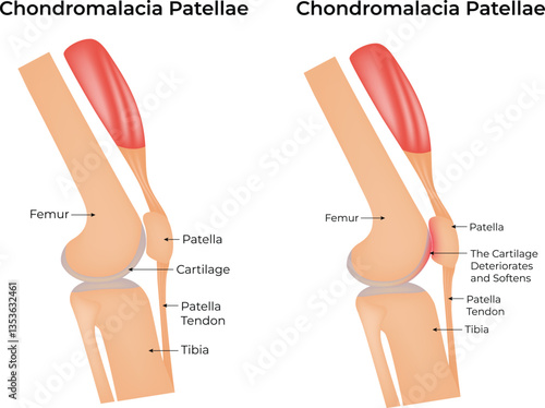 Chondromalacia Patellae Medical Illustration – Knee Joint Anatomy Showing Patellar Cartilage Deterioration Vector Illustration.