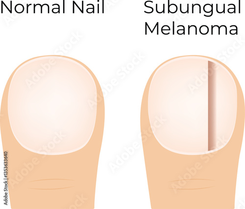 Subungual Melanoma vs Normal Nail