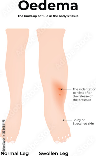 Oedema in the Leg